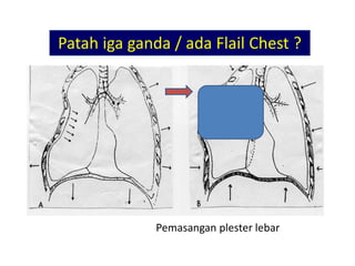 Pemasangan plester lebar
 