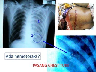 37
1
2
Ada hemotoraks?
PASANG CHEST TUBE
 