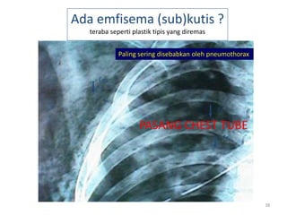 38
Ada emfisema (sub)kutis ?
teraba seperti plastik tipis yang diremas
Paling sering disebabkan oleh pneumothorax
Fr
Fr
Em
PASANG CHEST TUBE
 