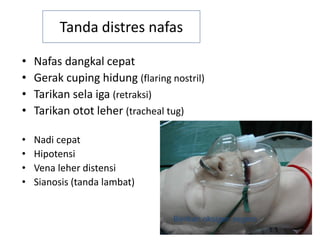 5
Tanda distres nafas
• Nafas dangkal cepat
• Gerak cuping hidung (flaring nostril)
• Tarikan sela iga (retraksi)
• Tarikan otot leher (tracheal tug)
• Nadi cepat
• Hipotensi
• Vena leher distensi
• Sianosis (tanda lambat)
Berikan oksigen segera
 