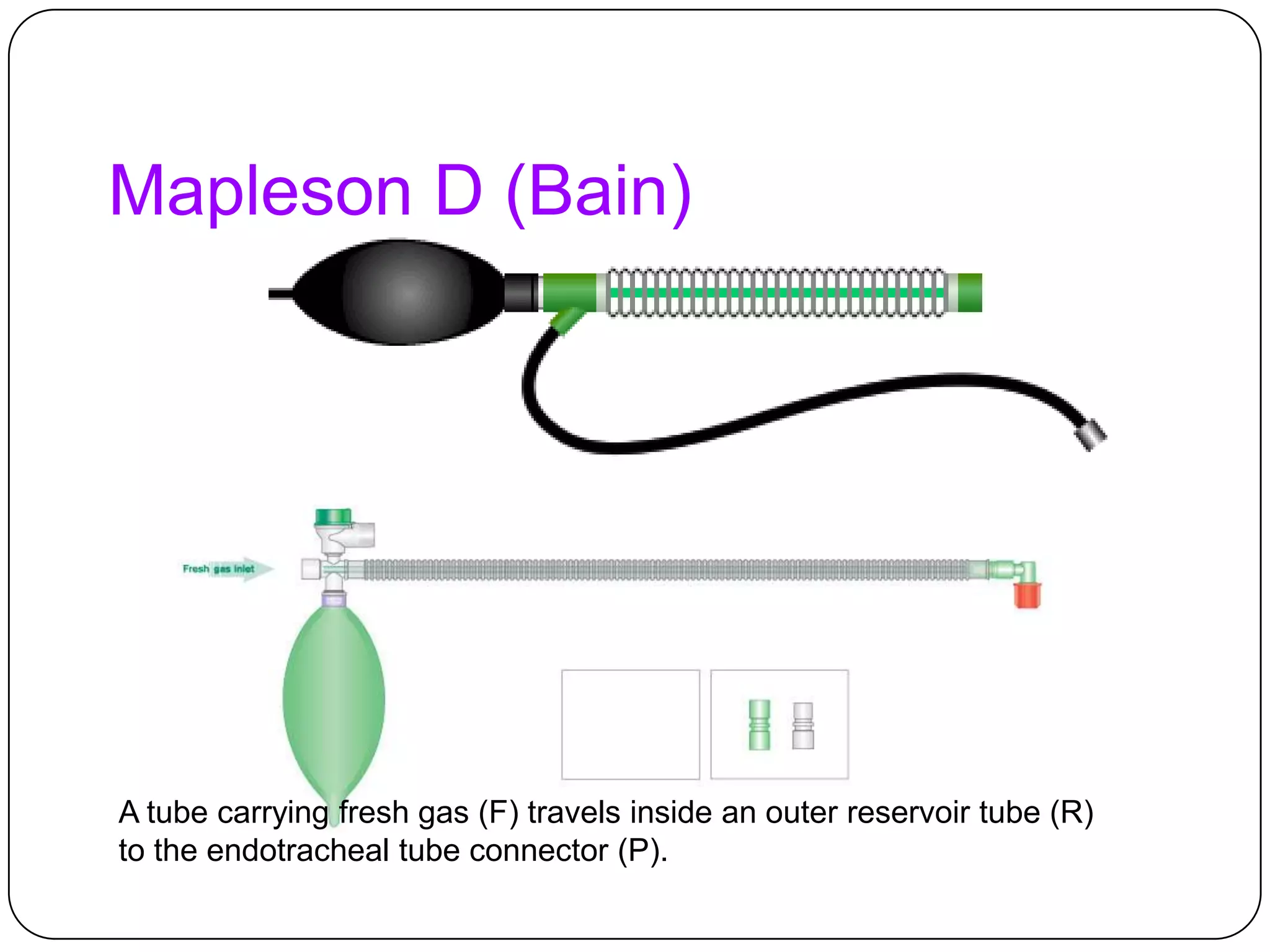 Mapleson D (Bain)
A tube carrying fresh gas (F) travels inside an outer reservoir tube (R)
to the endotracheal tube connector (P).
 