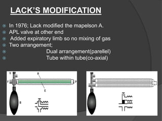 LACK’S MODIFICATION







In 1976; Lack modified the mapelson A.
APL valve at other end
Added expiratory limb so no mixing of gas
Two arrangement;
Dual arrangement(parellel)
Tube within tube(co-axial)

 