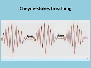 Cheyne-stokes breathing
 