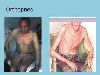 Orthopnea
 