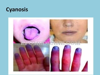 Cyanosis
 