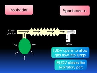 Inspiration Spontaneous
EUDV closes the
expiratory port
IUDV opens to allow
gas flow into lungs
Fresh
gas flow
Patient
 