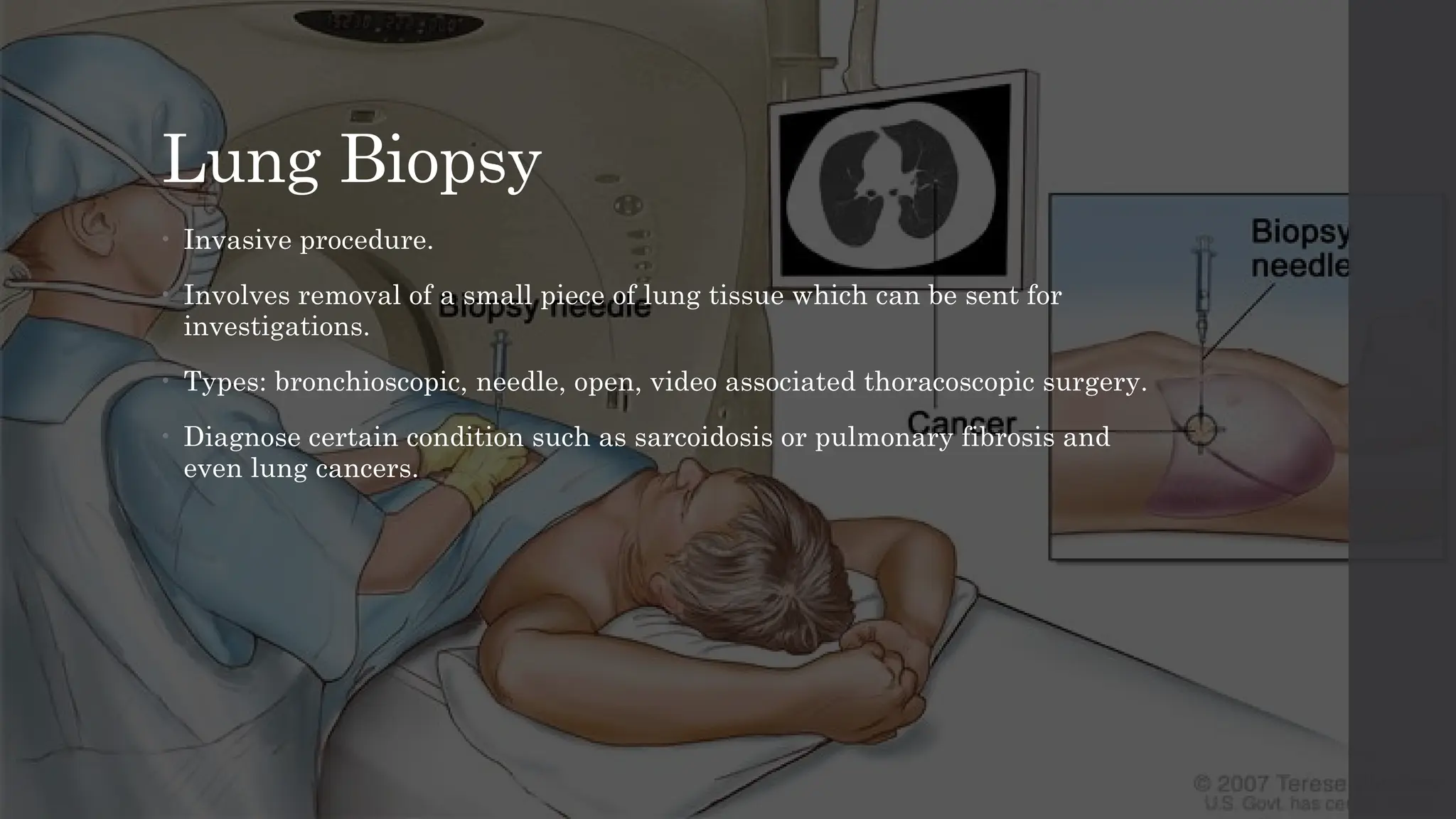 Lung Biopsy
• Invasive procedure.
• Involves removal of a small piece of lung tissue which can be sent for
investigations.
• Types: bronchioscopic, needle, open, video associated thoracoscopic surgery.
• Diagnose certain condition such as sarcoidosis or pulmonary fibrosis and
even lung cancers.
 
