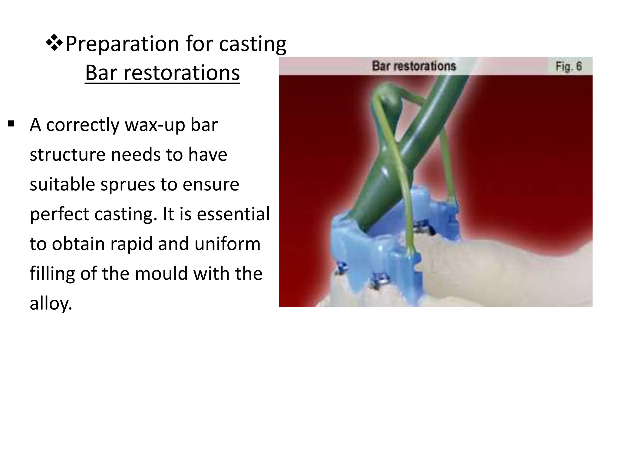 Preparation for casting
Bar restorations
 A correctly wax-up bar
structure needs to have
suitable sprues to ensure
perfect casting. It is essential
to obtain rapid and uniform
filling of the mould with the
alloy.
 