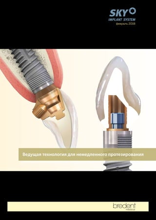 Немедленная Имплантация С Системой Sky От Bredent Medical | PDF