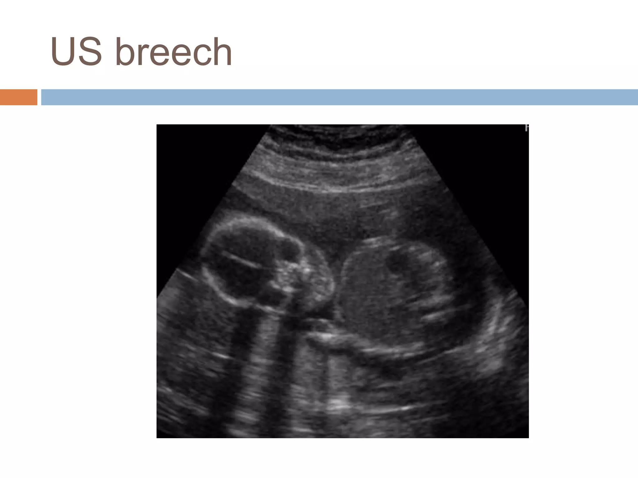 US breech
 