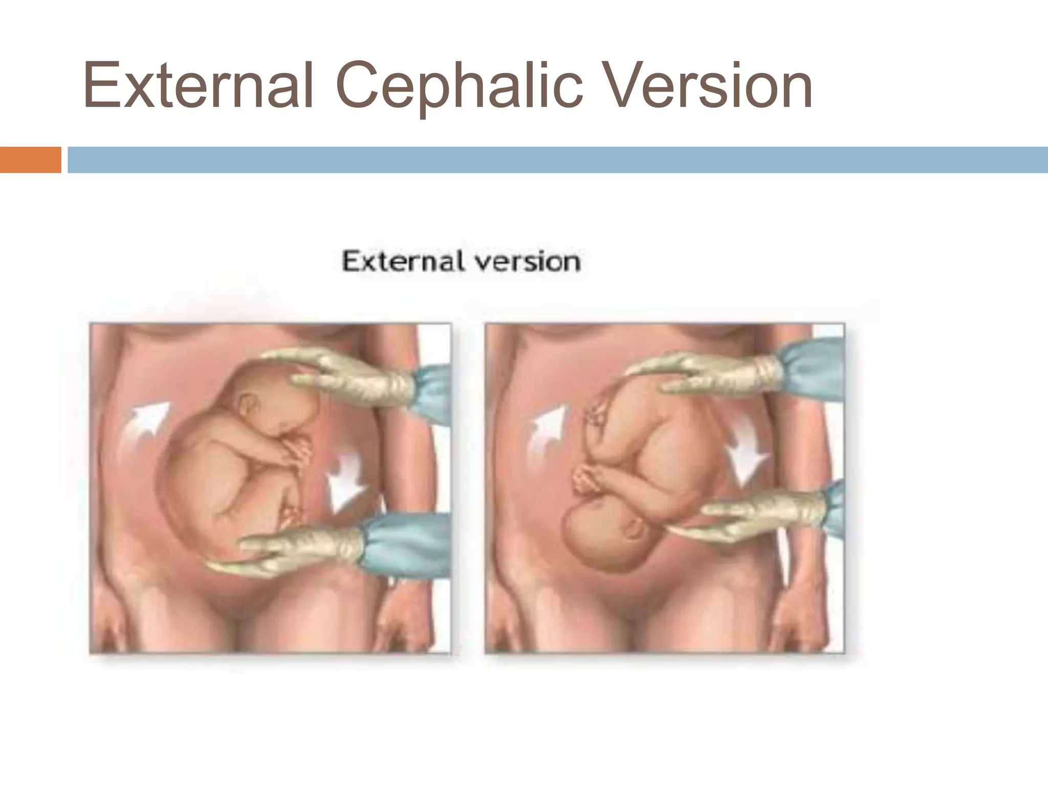 External Cephalic Version
 