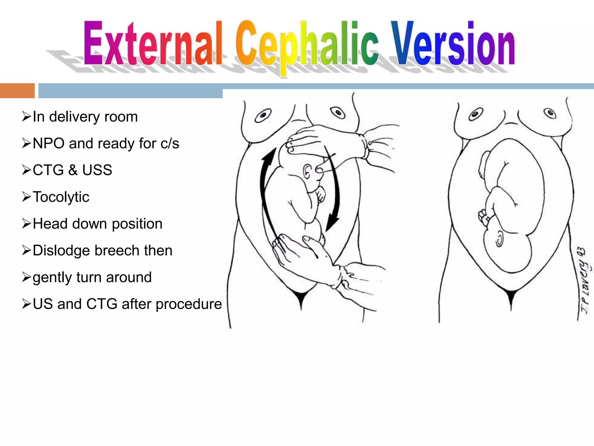 In delivery room
NPO and ready for c/s
CTG & USS
Tocolytic
Head down position
Dislodge breech then
gently turn around
US and CTG after procedure.
 