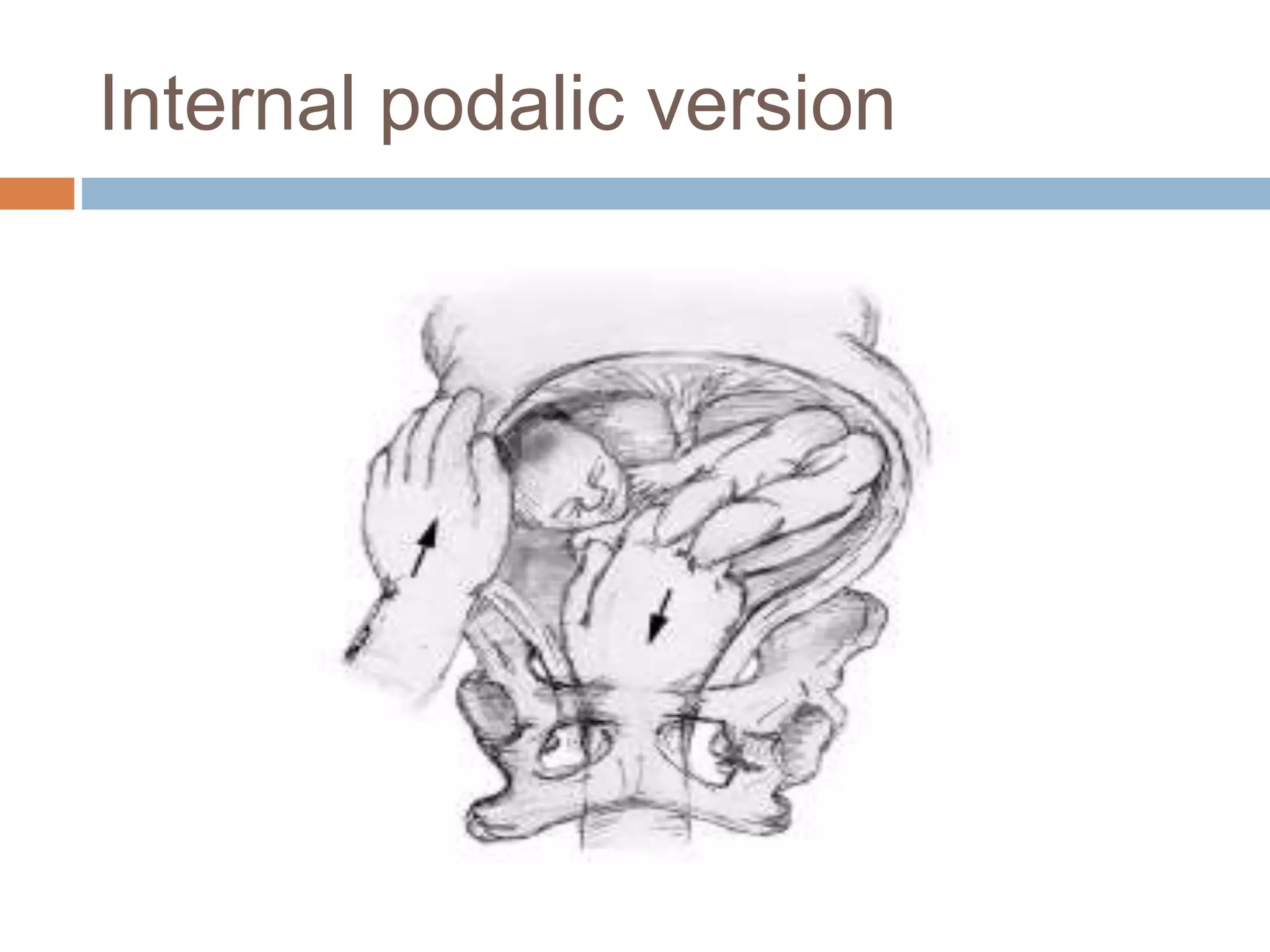 Internal podalic version
 