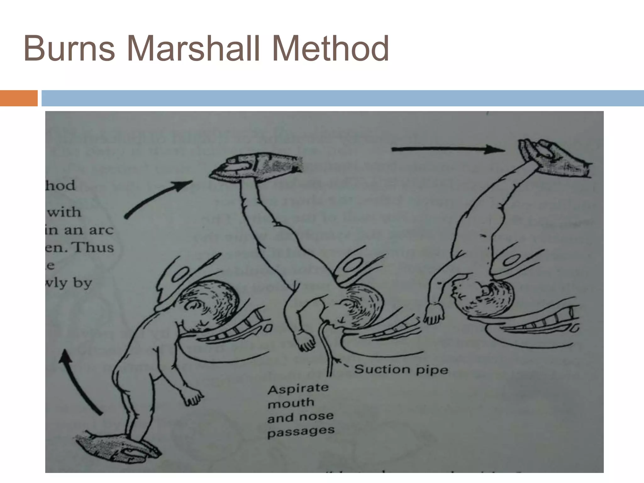 Burns Marshall Method
 