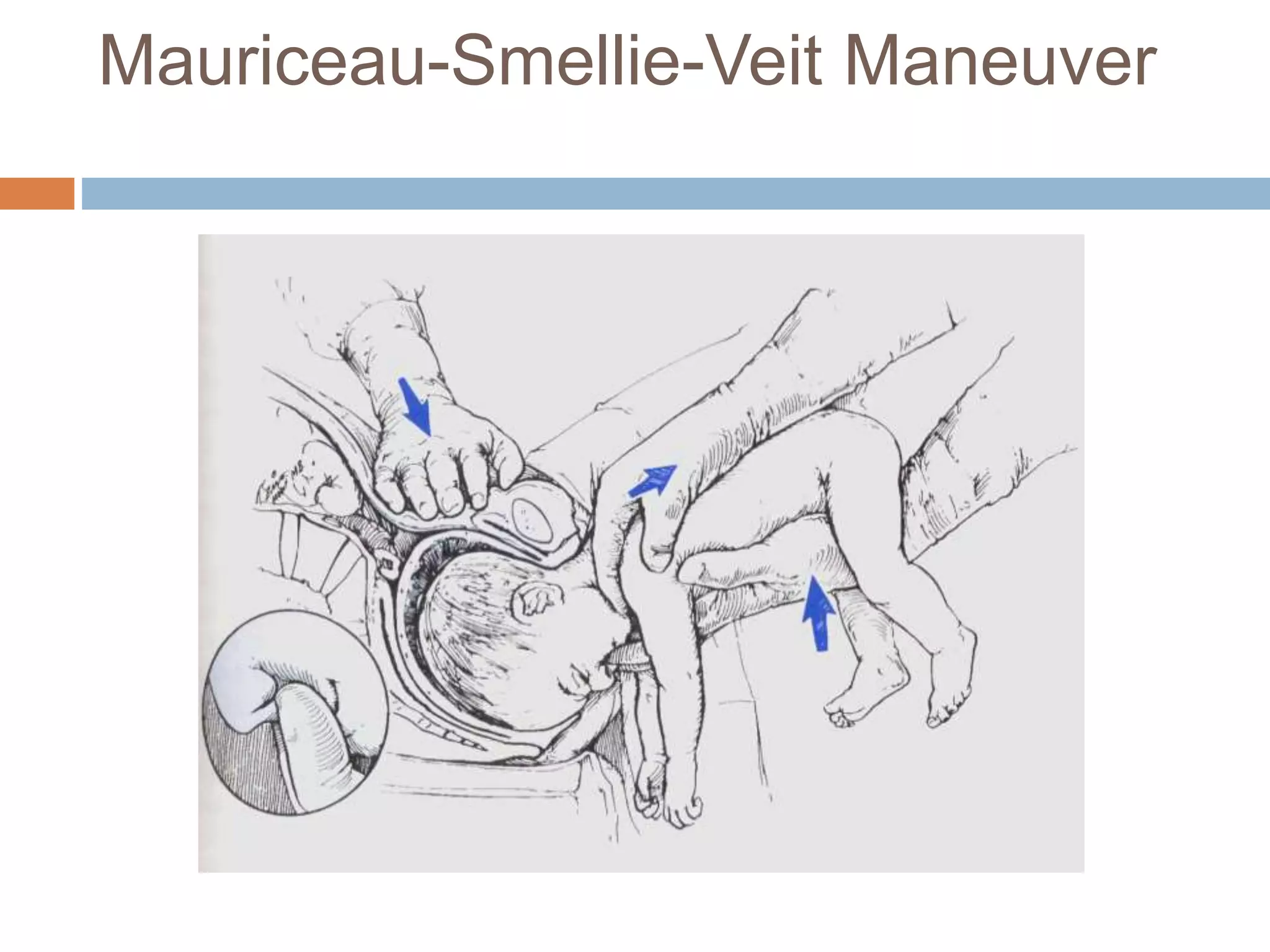 Mauriceau-Smellie-Veit Maneuver
 