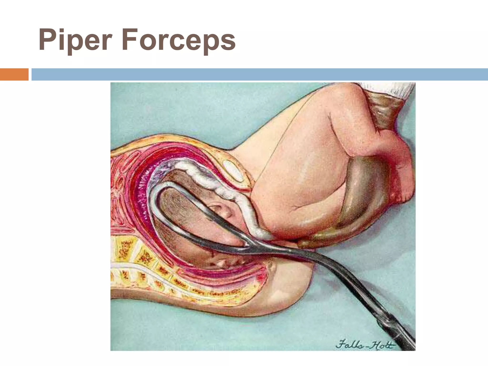 Piper Forceps
 