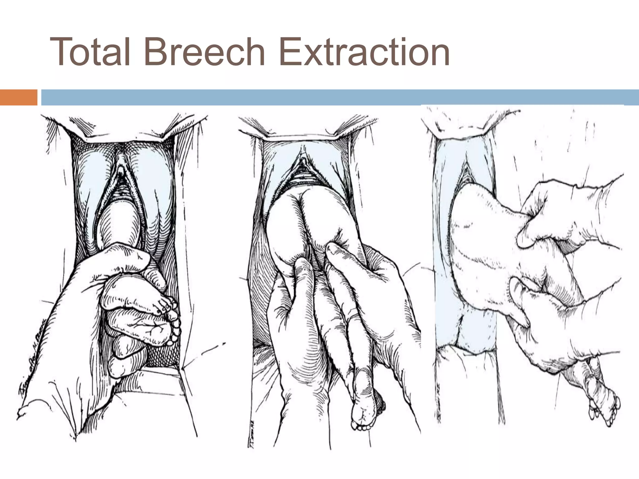 Total Breech Extraction
 