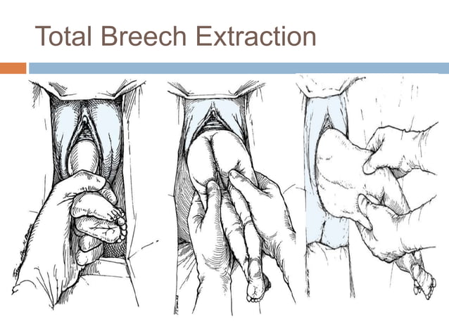 Management of Breech Presentation - 2017 - BJOG: An International ...