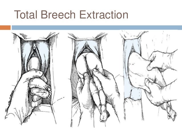 presentation breech extraction