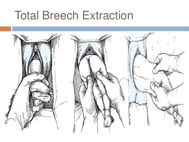 Breech Presentation breech-presentation