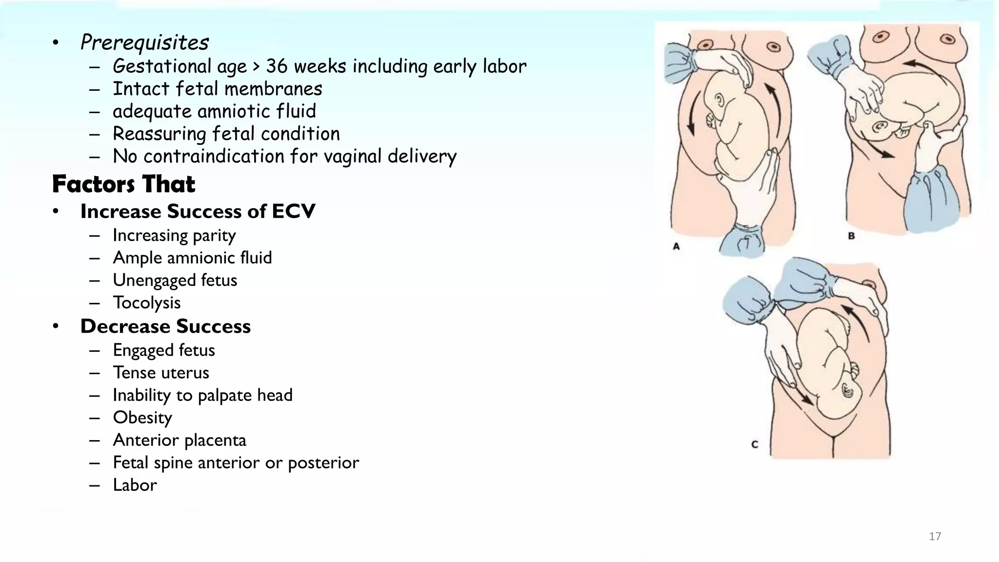 • Prerequisites
– Gestational age > 36 weeks including early labor
– Intact fetal membranes
– adequate amniotic fluid
– Reassuring fetal condition
– No contraindication for vaginal delivery
Factors That
• Increase Success of ECV
– Increasing parity
– Ample amnionic fluid
– Unengaged fetus
– Tocolysis
• Decrease Success
– Engaged fetus
– Tense uterus
– Inability to palpate head
– Obesity
– Anterior placenta
– Fetal spine anterior or posterior
– Labor
17
 