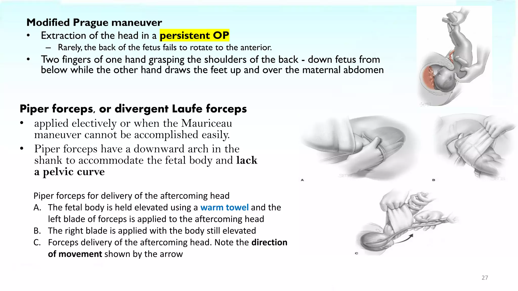 Modified Prague maneuver
• Extraction of the head in a persistent OP
– Rarely, the back of the fetus fails to rotate to the anterior.
• Two fingers of one hand grasping the shoulders of the back - down fetus from
below while the other hand draws the feet up and over the maternal abdomen
27
Piper forceps, or divergent Laufe forceps
• applied electively or when the Mauriceau
maneuver cannot be accomplished easily.
• Piper forceps have a downward arch in the
shank to accommodate the fetal body and lack
a pelvic curve
Piper forceps for delivery of the aftercoming head
A. The fetal body is held elevated using a warm towel and the
left blade of forceps is applied to the aftercoming head
B. The right blade is applied with the body still elevated
C. Forceps delivery of the aftercoming head. Note the direction
of movement shown by the arrow
 