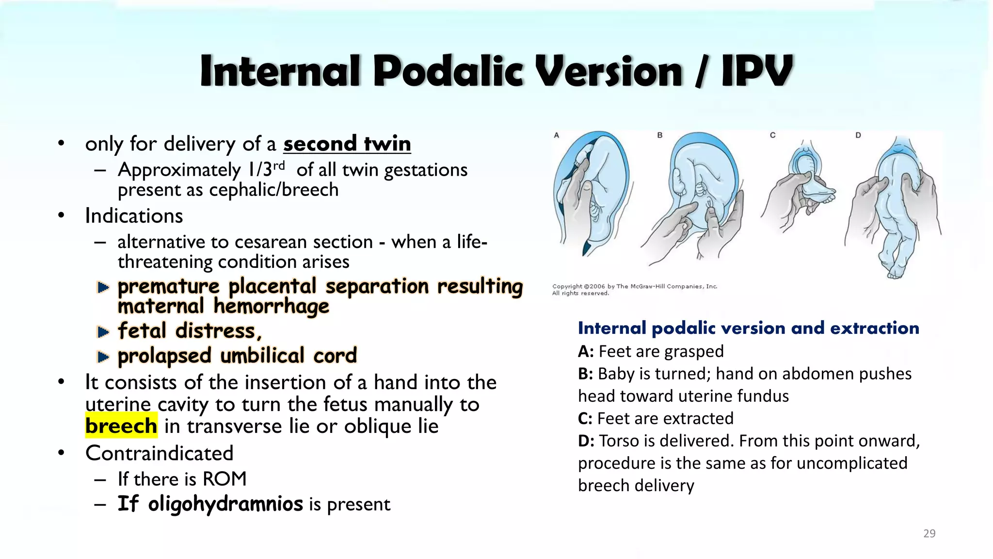 Internal Podalic Version / IPV
• only for delivery of a second twin
– Approximately 1/3rd of all twin gestations
present as cephalic/breech
• Indications
– alternative to cesarean section - when a life-
threatening condition arises
premature placental separation resulting
maternal hemorrhage
fetal distress,
prolapsed umbilical cord
• It consists of the insertion of a hand into the
uterine cavity to turn the fetus manually to
breech in transverse lie or oblique lie
• Contraindicated
– If there is ROM
– If oligohydramnios is present
29
Internal podalic version and extraction
A: Feet are grasped
B: Baby is turned; hand on abdomen pushes
head toward uterine fundus
C: Feet are extracted
D: Torso is delivered. From this point onward,
procedure is the same as for uncomplicated
breech delivery
 