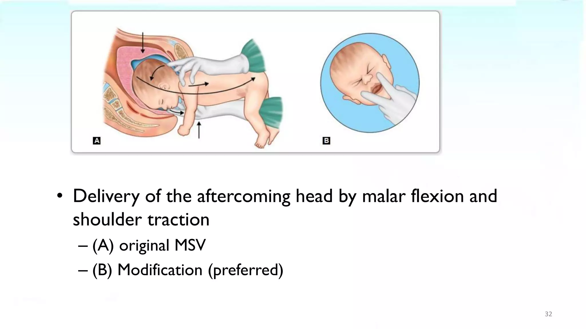 • Delivery of the aftercoming head by malar flexion and
shoulder traction
– (A) original MSV
– (B) Modification (preferred)
32
 