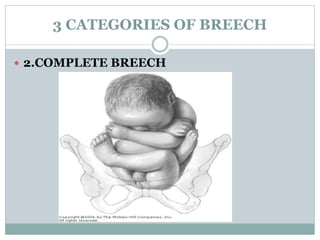 BREECH.ppt