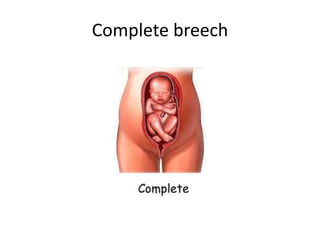 Complete breech
 