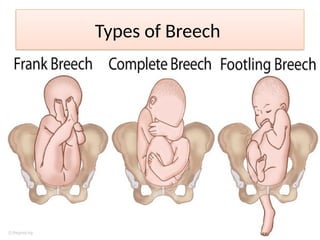 Breech presentation, types and its management | PPTX