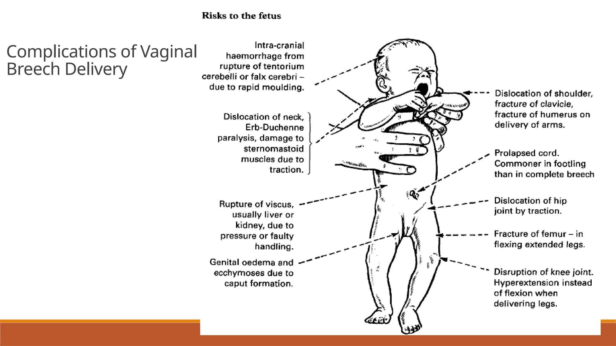 Breech presentation, types, manuvers, definition , diagnosis | PPTX