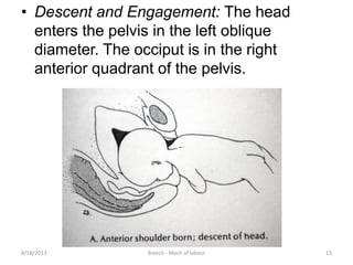 Breech mech of labour | PPTX