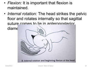 Breech mech of labour | PPTX
