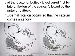 Breech mech of labour | PPTX