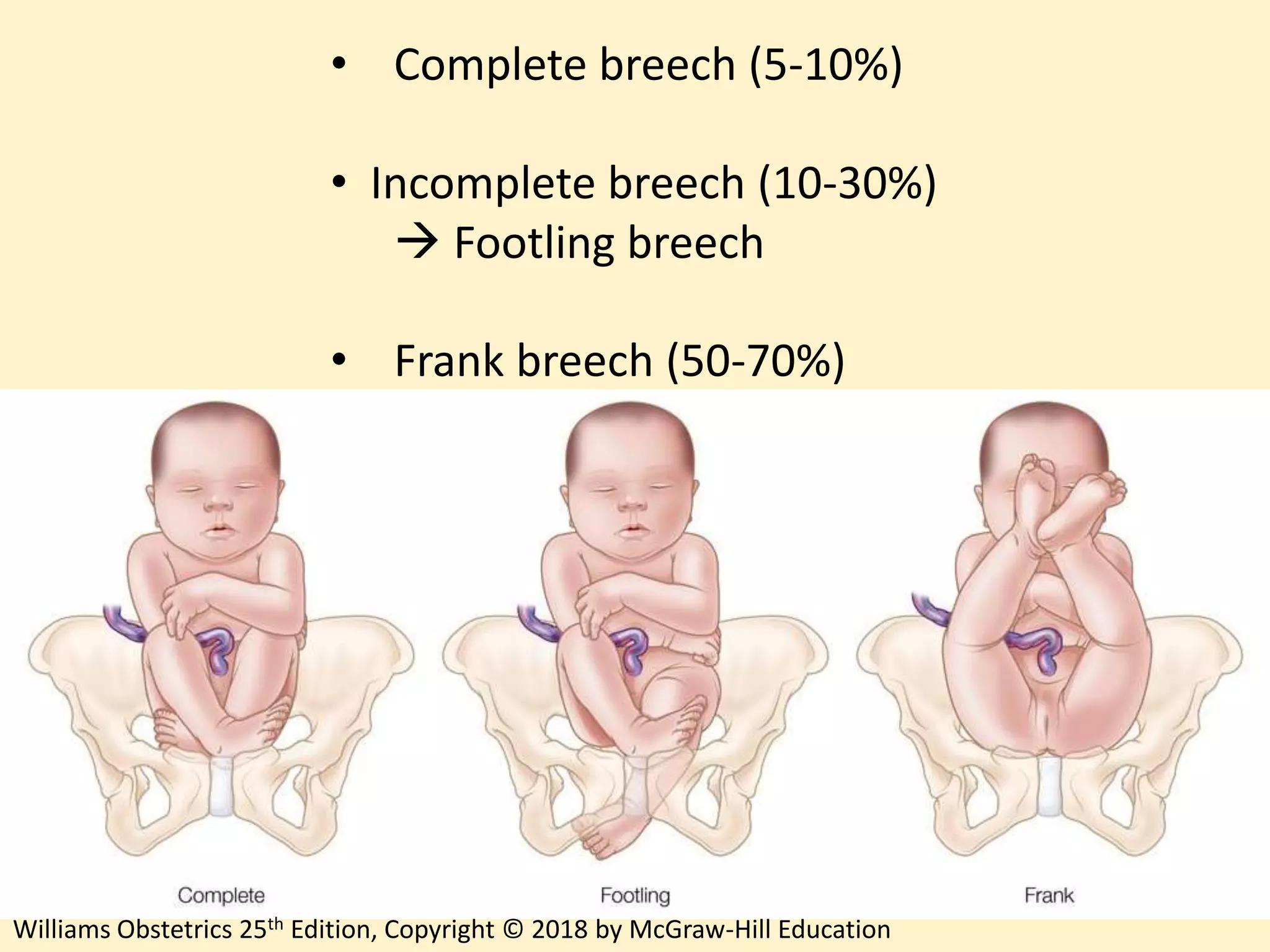 Breech Delivery | PPTX