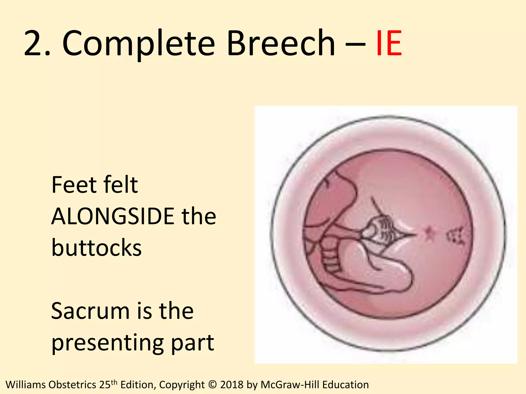 Breech Delivery | PPTX