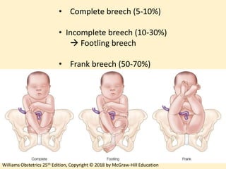 Breech Delivery | PPTX