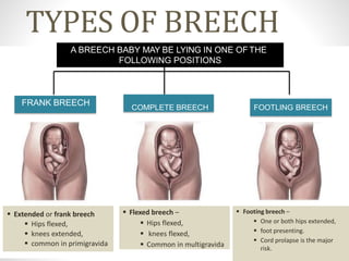 Breech presentation | PPTX