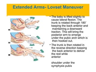 breech-presentation.pdfghghvghjhhhhhhhhh | PDF