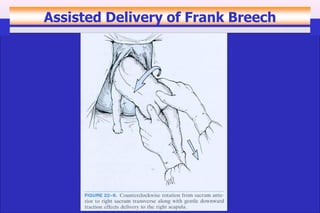 -breech-presentation bleeding in early pregnancy during pregnancy(2).pdf