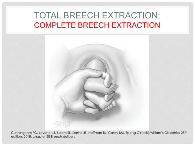 Steps in Partial & Complete Breech Delviery | PPT