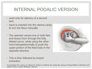 Steps in Partial & Complete Breech Delviery | PDF