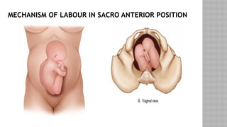 MECHANISM OF LABOUR IN SACRO ANTERIOR POSITION
 