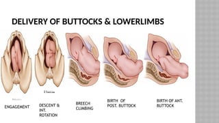 DELIVERY OF BUTTOCKS & LOWERLIMBS
ENGAGEMENT DESCENT &
INT.
ROTATION
BREECH
CLIMBING
BIRTH OF
POST. BUTTOCK
BIRTH OF ANT.
BUTTOCK
 