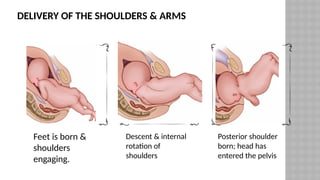 DELIVERY OF THE SHOULDERS & ARMS
Feet is born &
shoulders
engaging.
Descent & internal
rotation of
shoulders
Posterior shoulder
born; head has
entered the pelvis
 