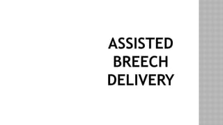 ASSISTED
BREECH
DELIVERY
 