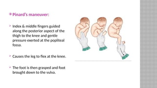  Pinard’s maneuver:
 Index & middle fingers guided
along the posterior aspect of the
thigh to the knee and gentle
pressure exerted at the popliteal
fossa.
 Causes the leg to flex at the knee.
 The foot is then grasped and foot
brought down to the vulva.
 