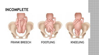 INCOMPLETE
FRANK BREECH FOOTLING KNEELING
 