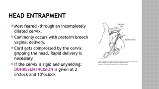 HEAD ENTRAPMENT
 Most feared -through an incompletely
dilated cervix.
 Commonly occurs with preterm breech
vaginal delivery.
 Cord gets compressed by the cervix
gripping the head. Rapid delivery is
necessary.
 If the cervix is rigid and unyielding:
DUHRSSEN INCISION is given at 2
o’clock and 10’oclock
 
